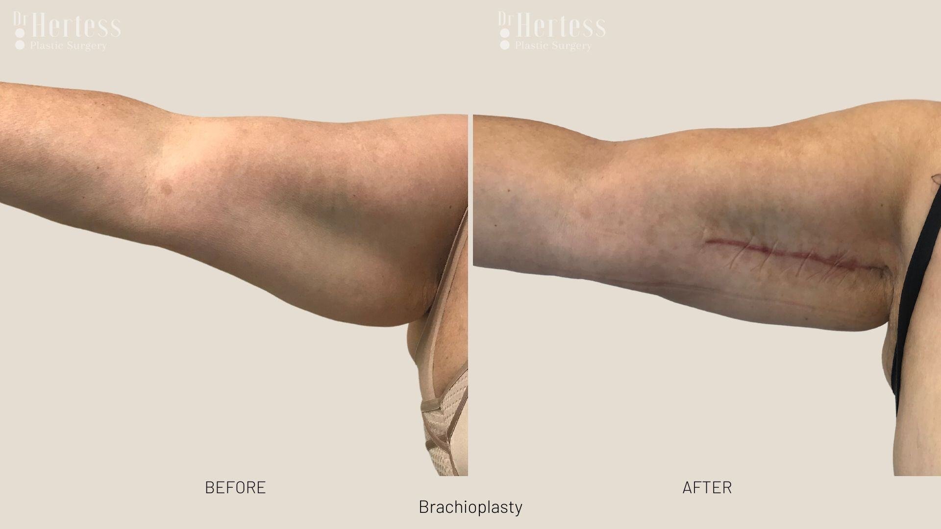 brachioplasty before and after photos