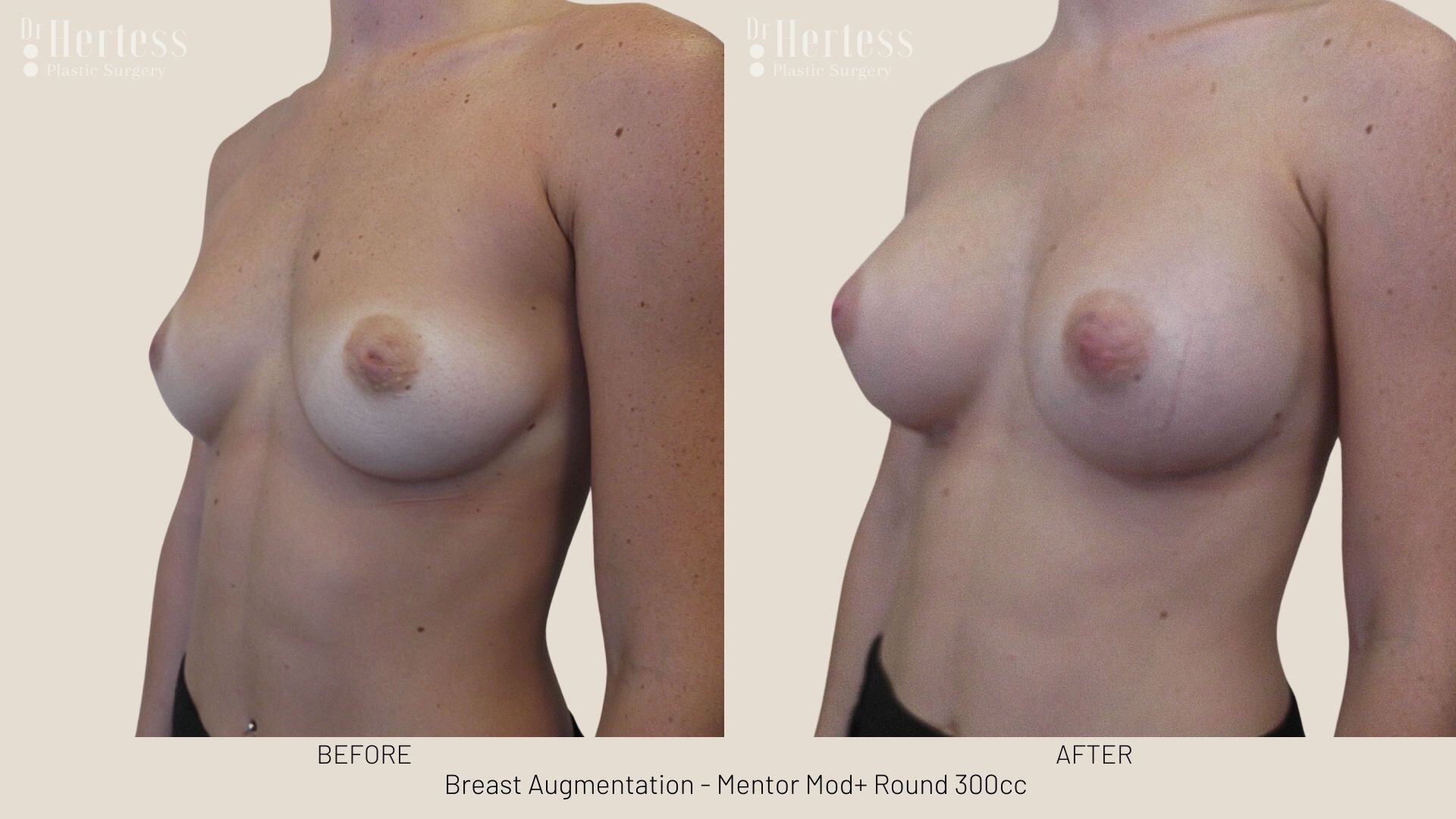 breast implants before and after