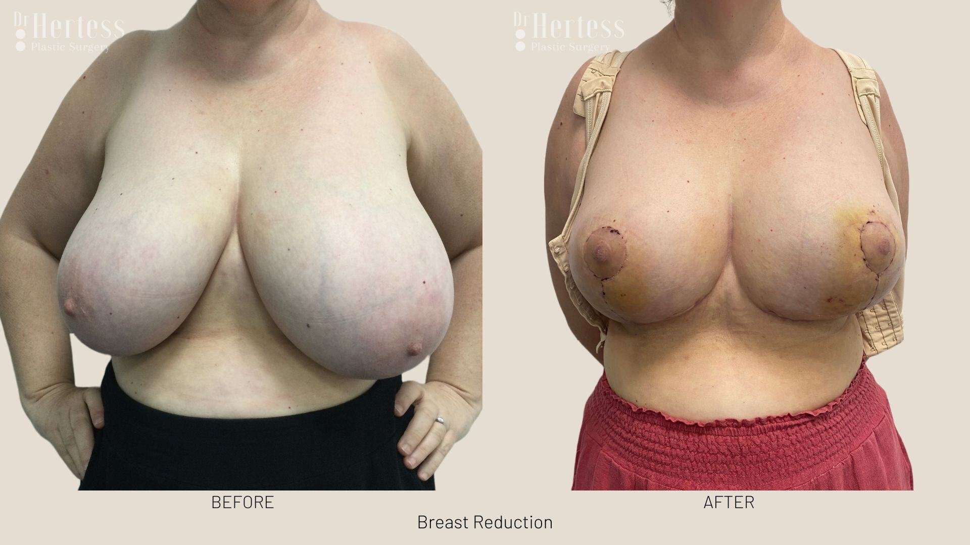 breast reduction before and after