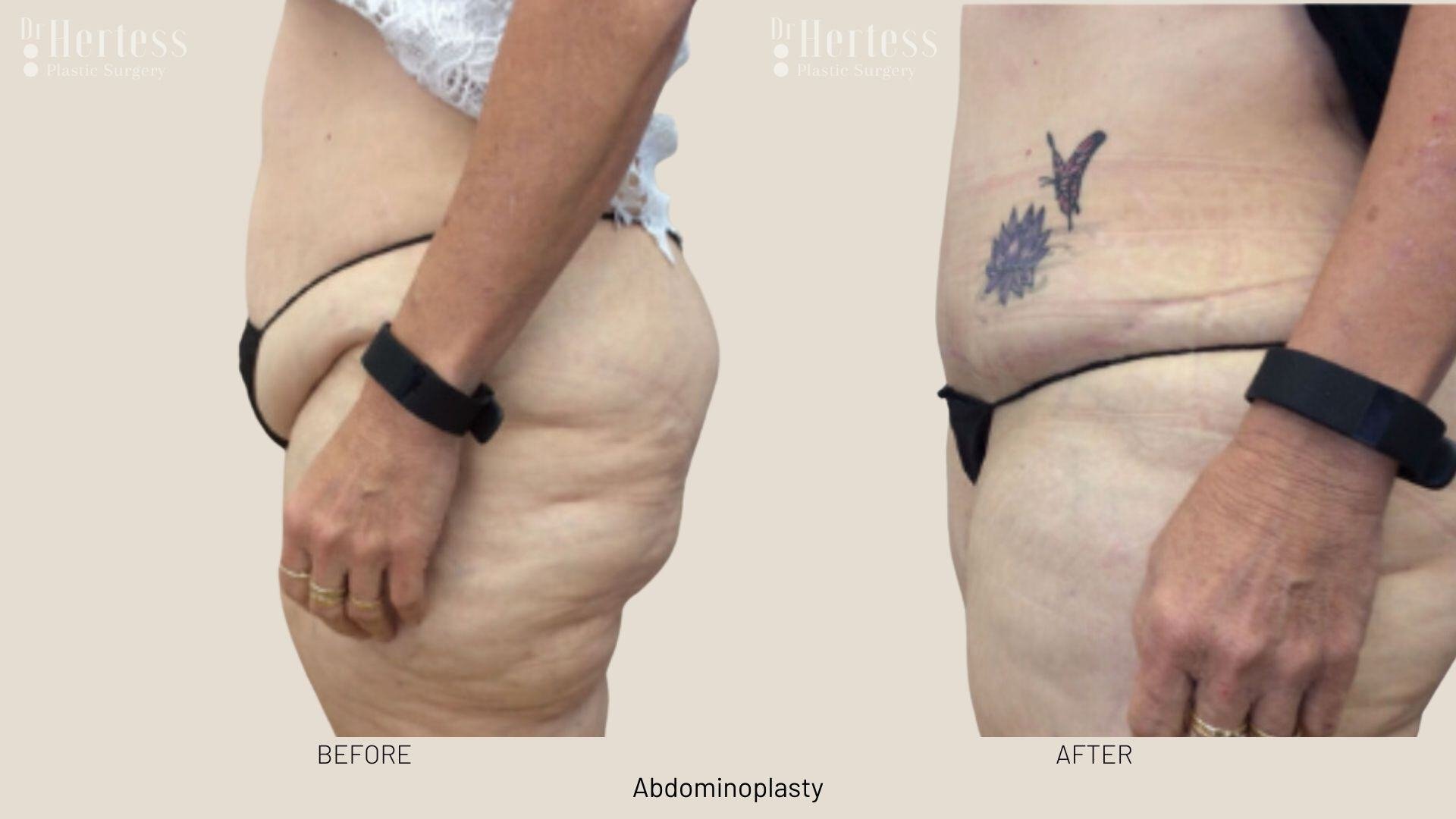 abdominoplasty before and after photos