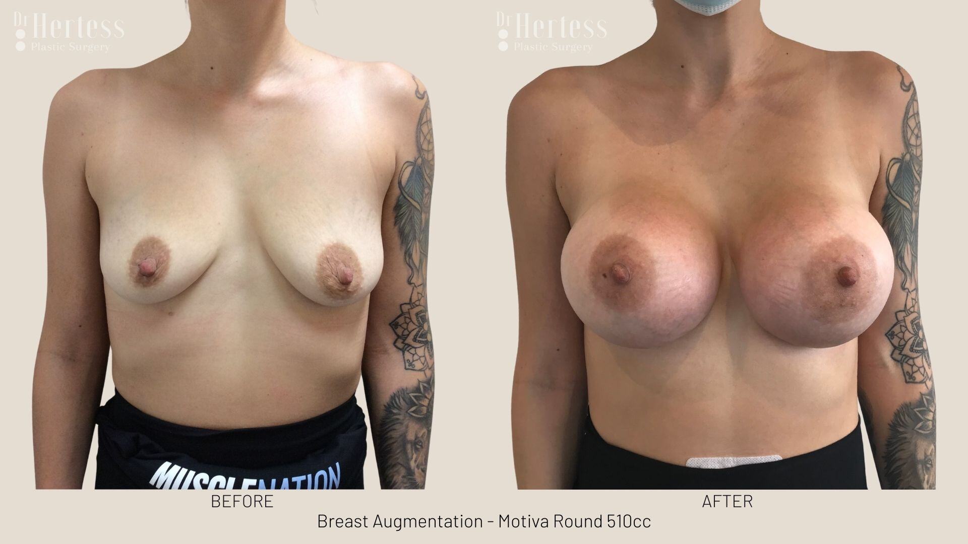 boob job photos before and after