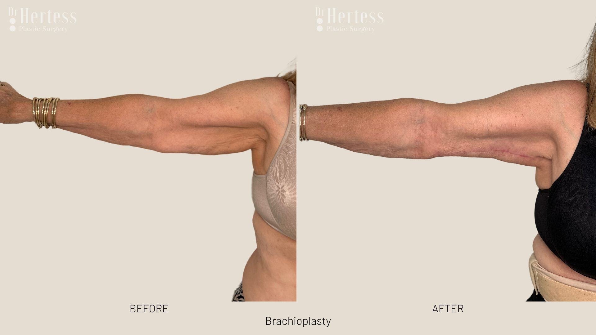brachioplasty before and after photos
