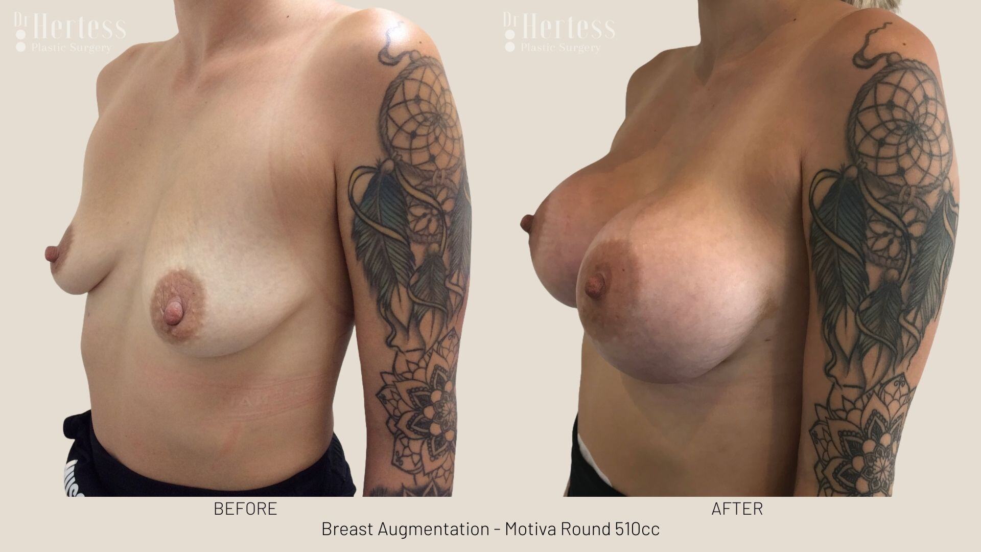 boob job photos before and after