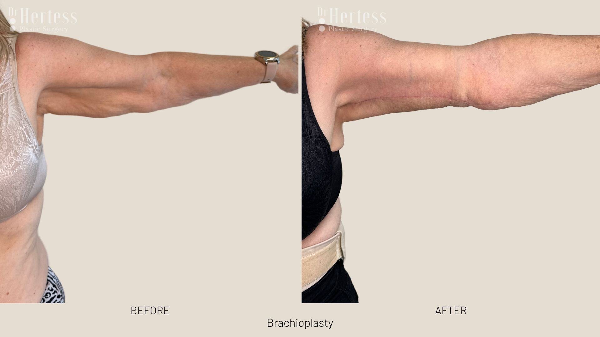 arm lift before and after photos