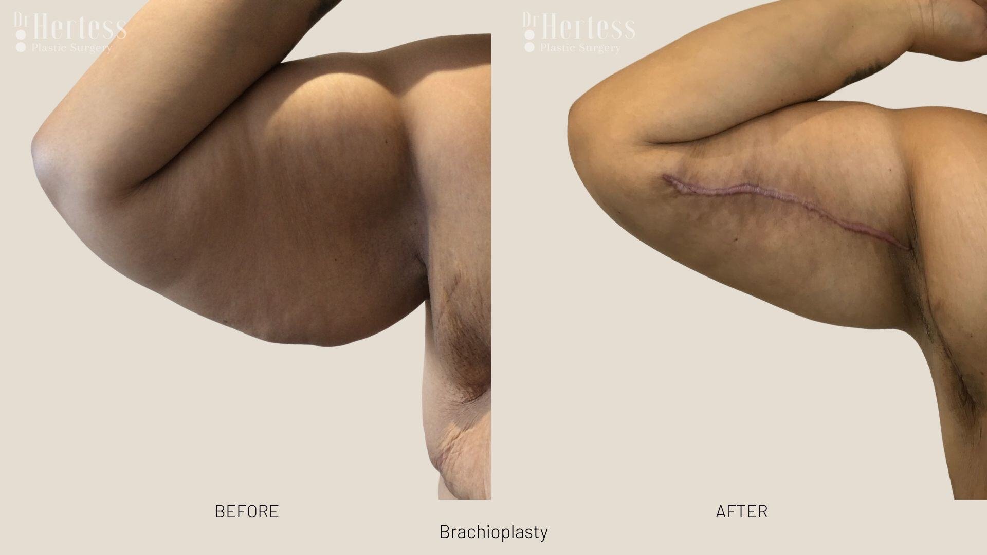 arm lift before and after photos