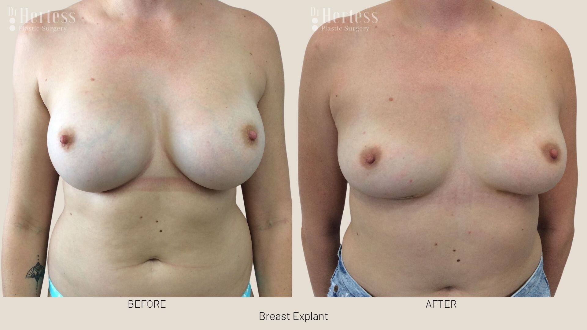 breast implant removal photos