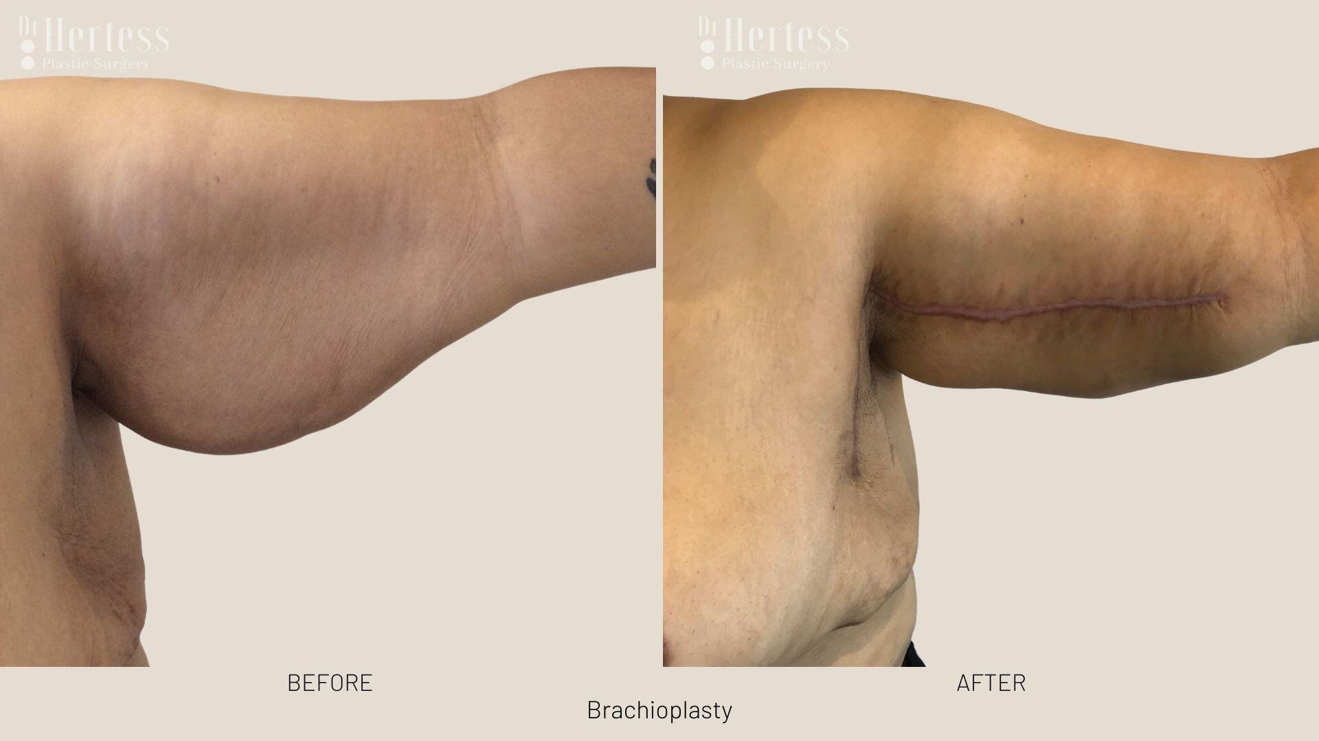 arm lift before and after photos