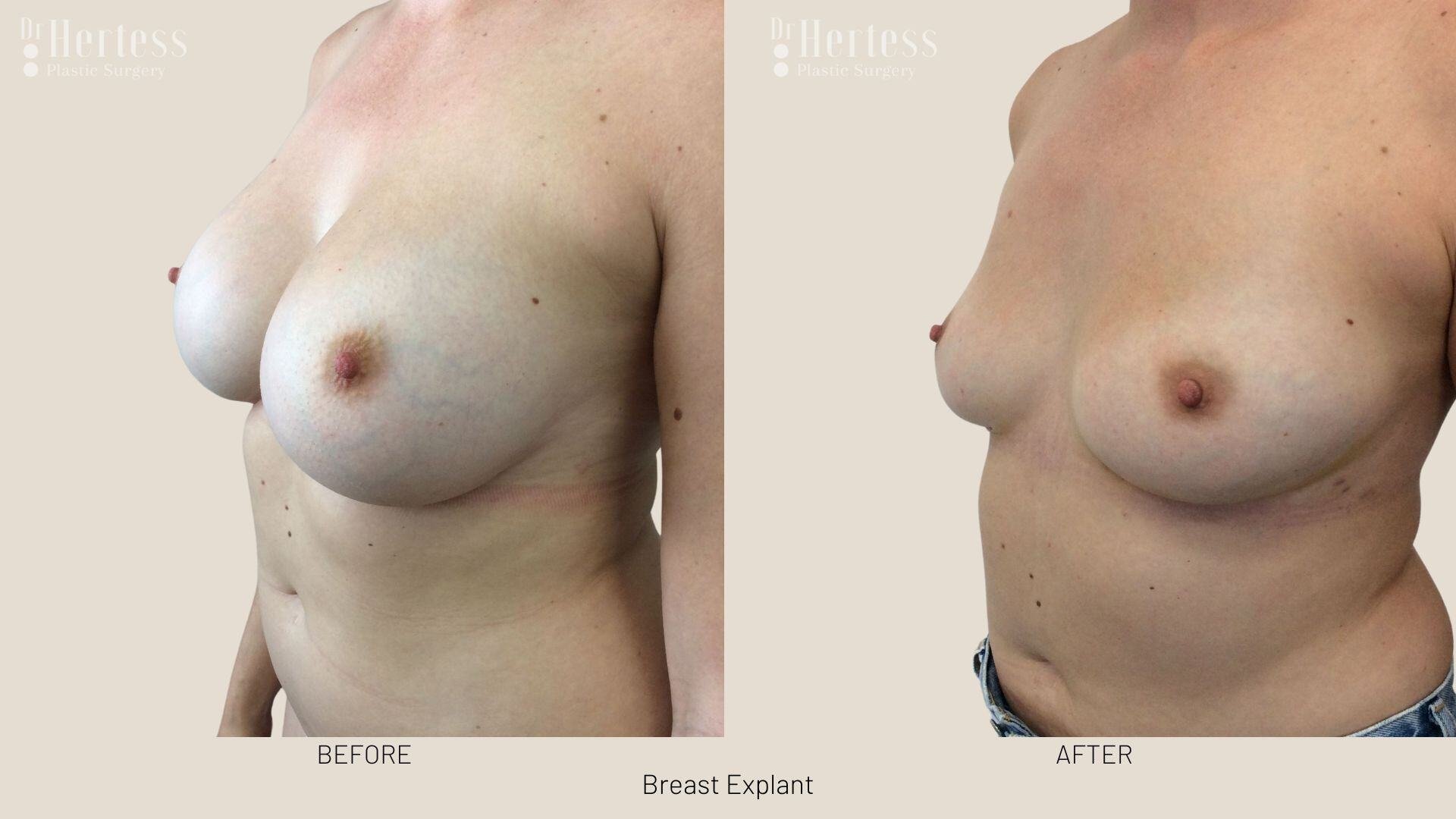 breast implant removal photos