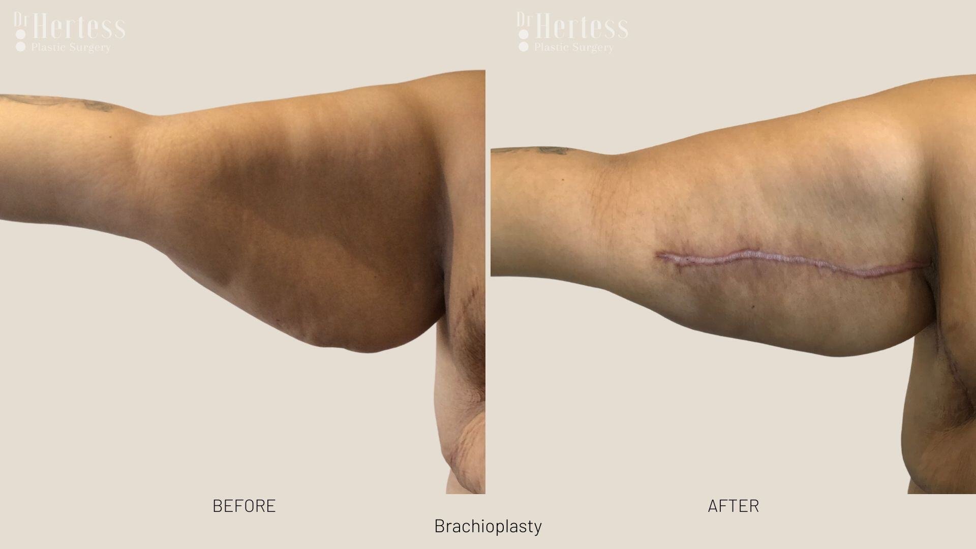 arm lift before and after photos