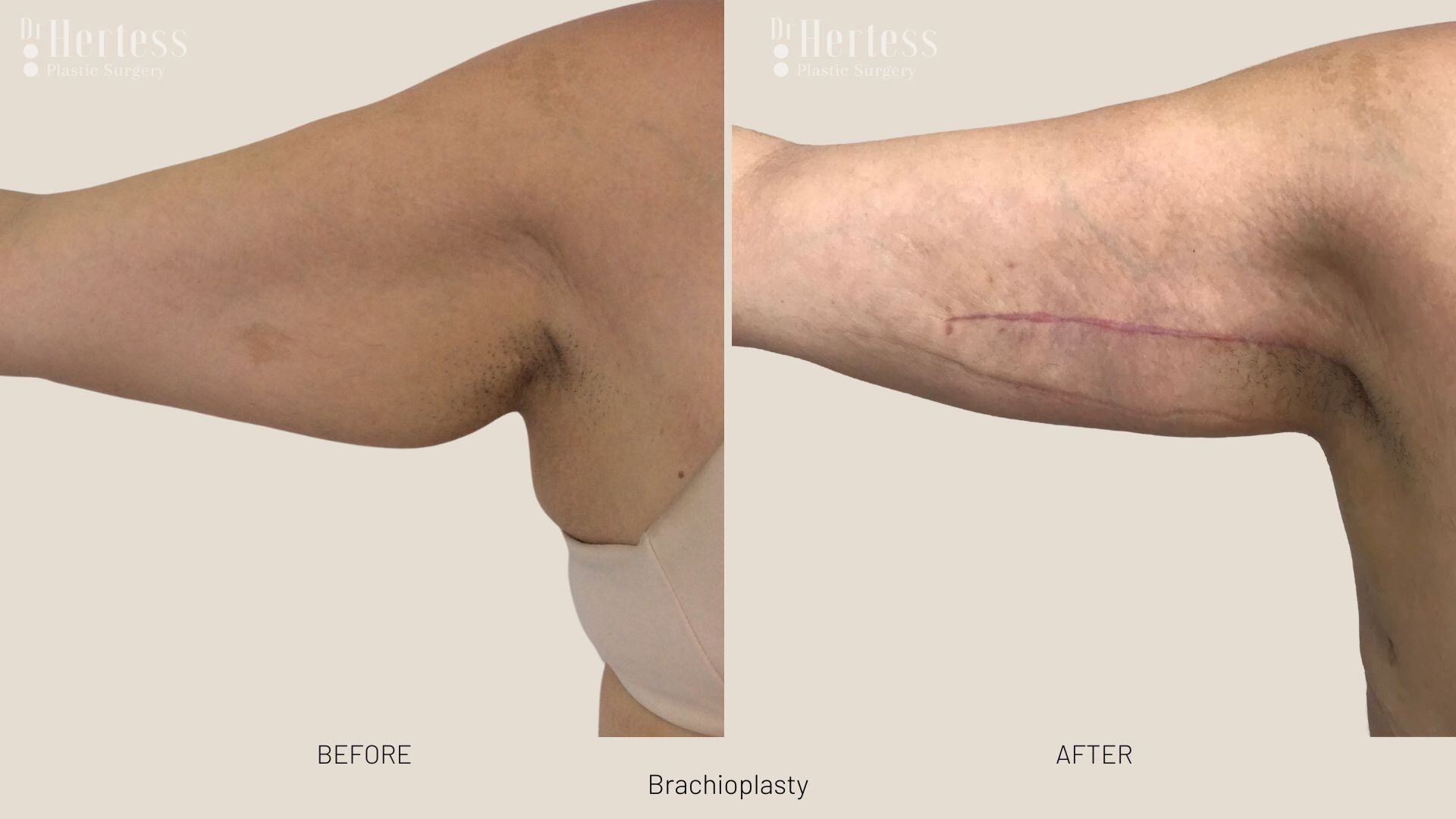 arm lift before and after photos