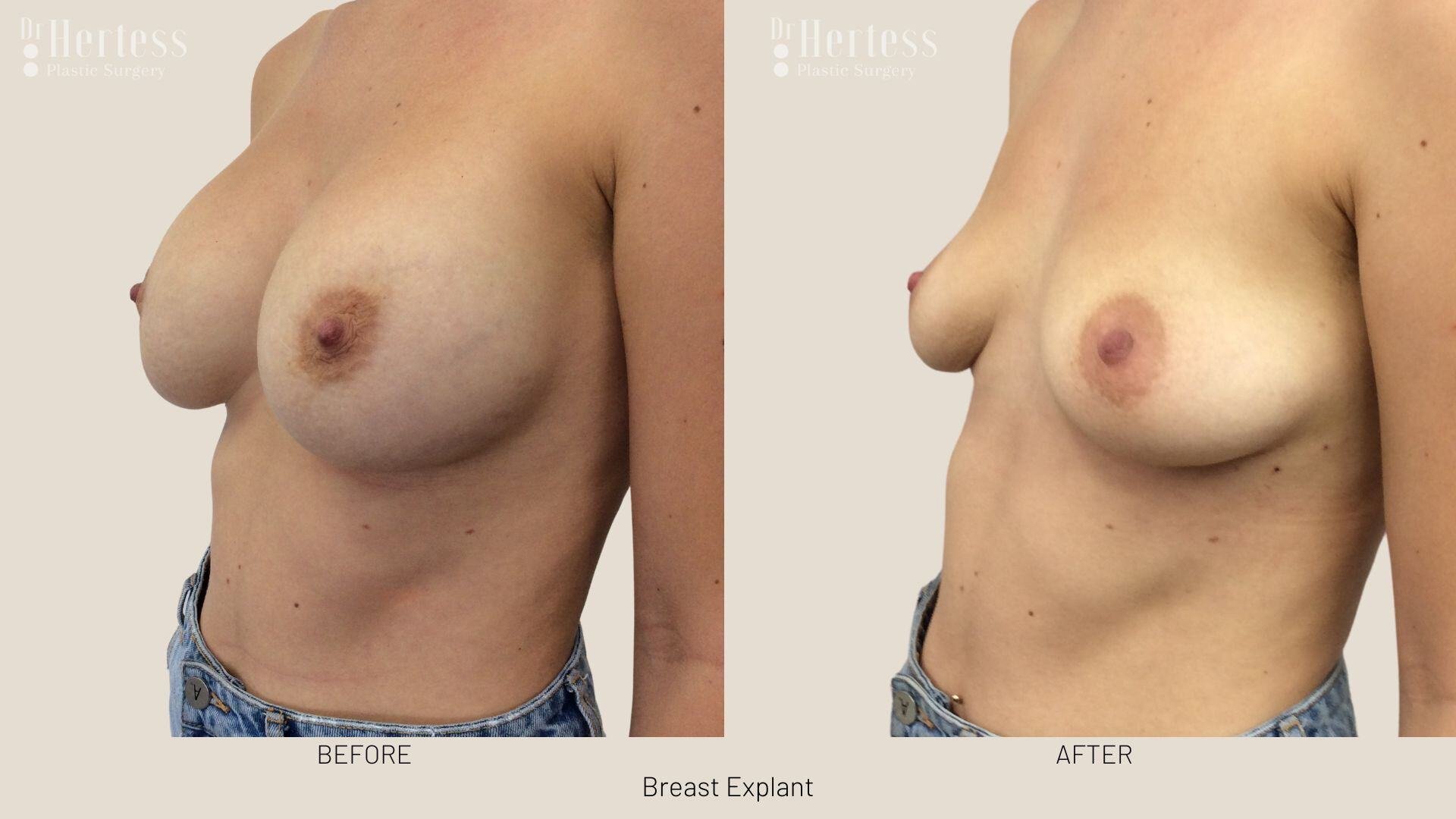 breast implant removal photos