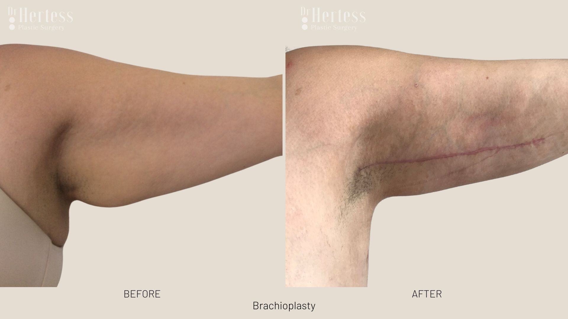 arm lift before and after photos