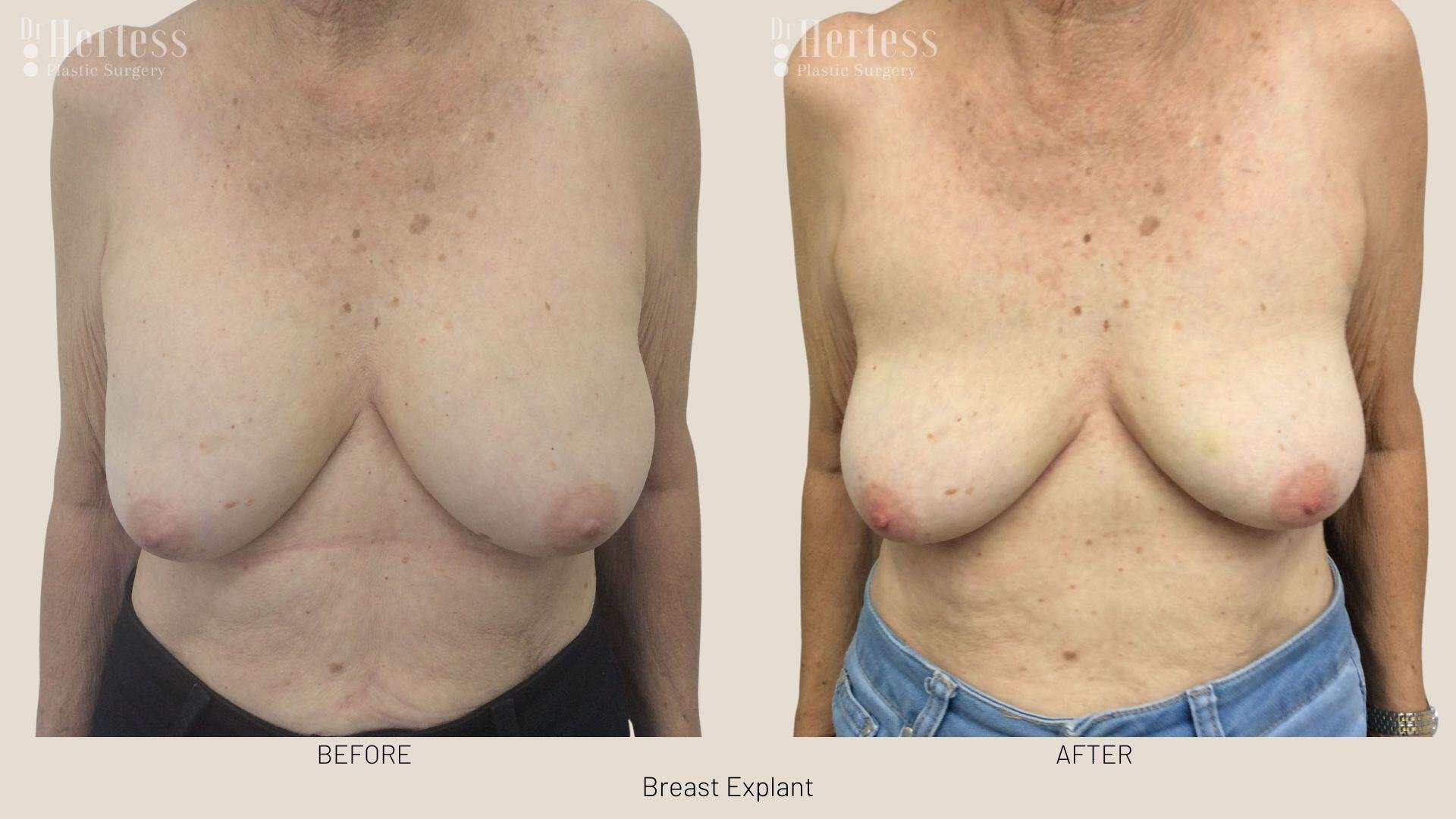 breast implant removal photos