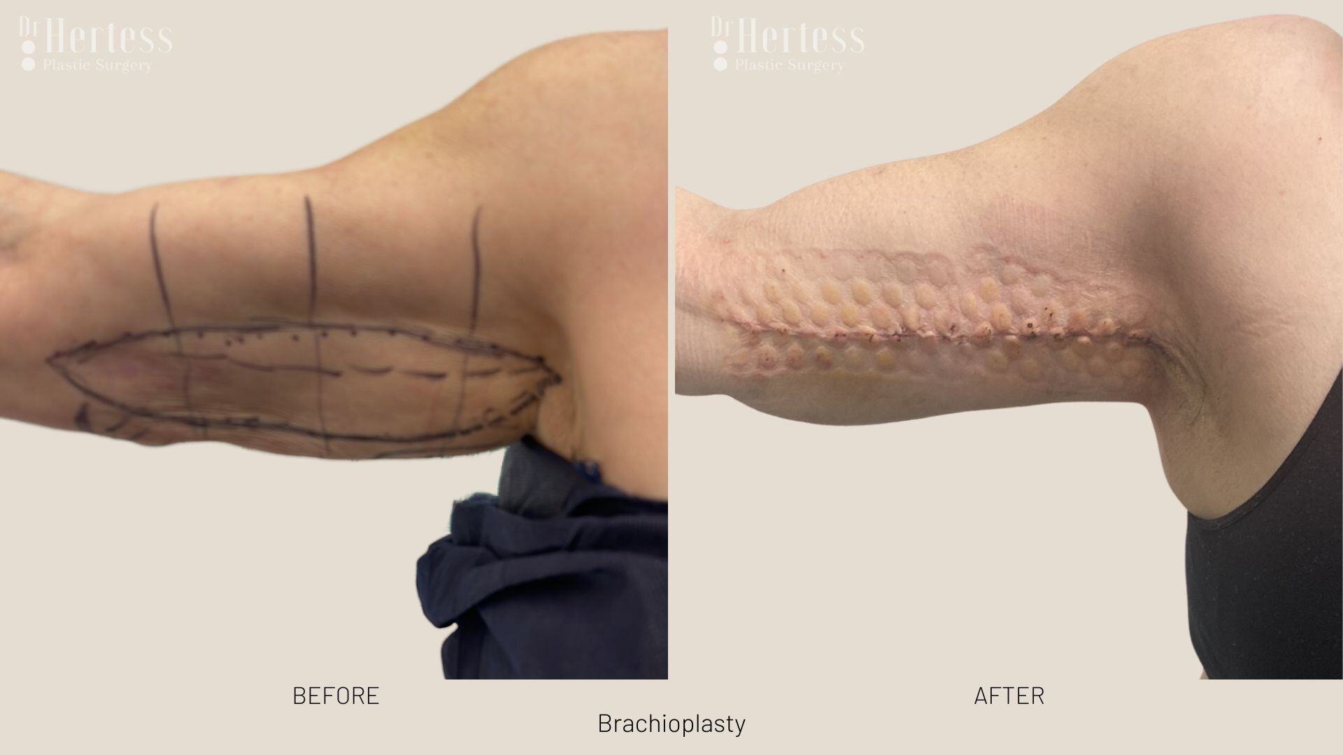 arm lift before and after photos