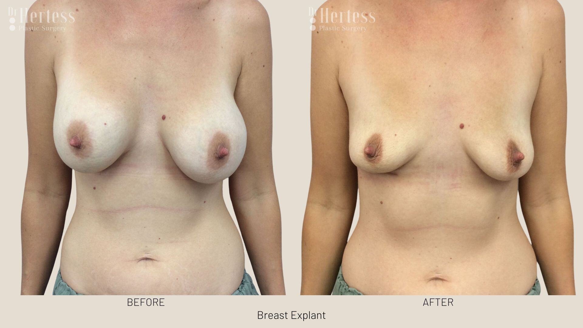 breast implant removal photos