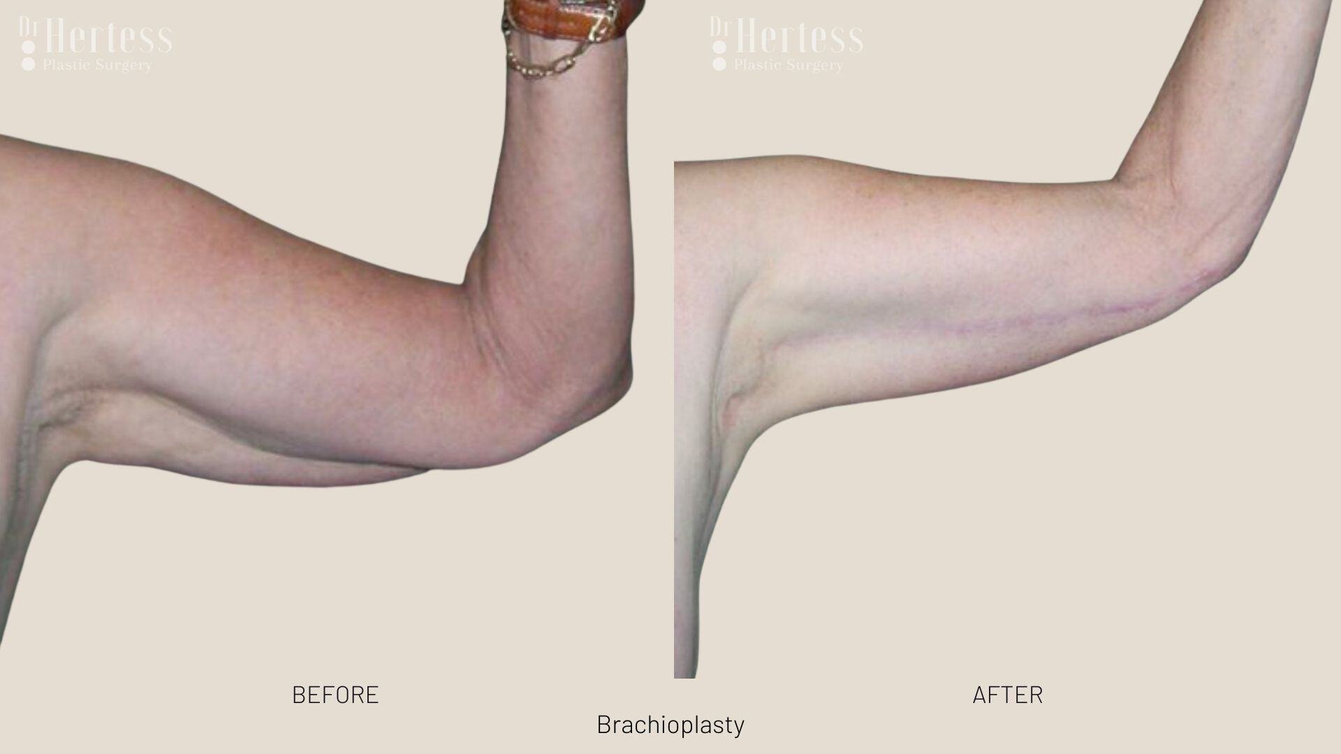 arm lift before and after photos