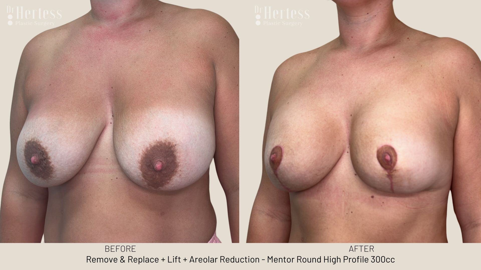 Gallery 2 (BBR, RR, RR+lift, explant, explant+lift, nipple, mastectomy, laser, FL) -1