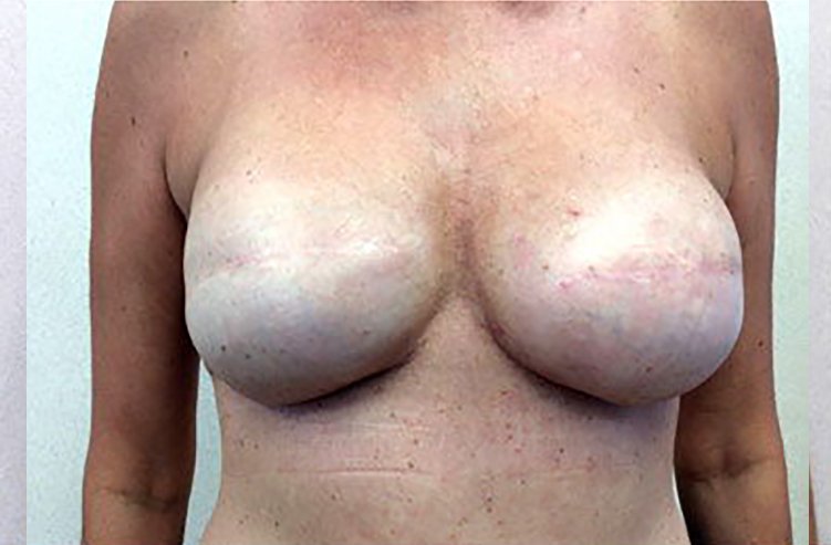 Mastopexy Breast Reconstruction After