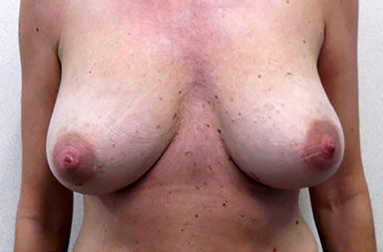 Breast Reconstruction Before