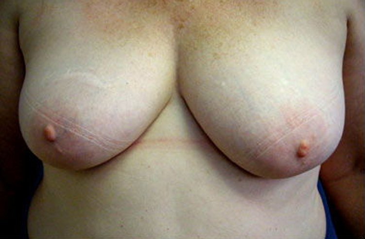 Mastopexy Breast Reconstruction Before